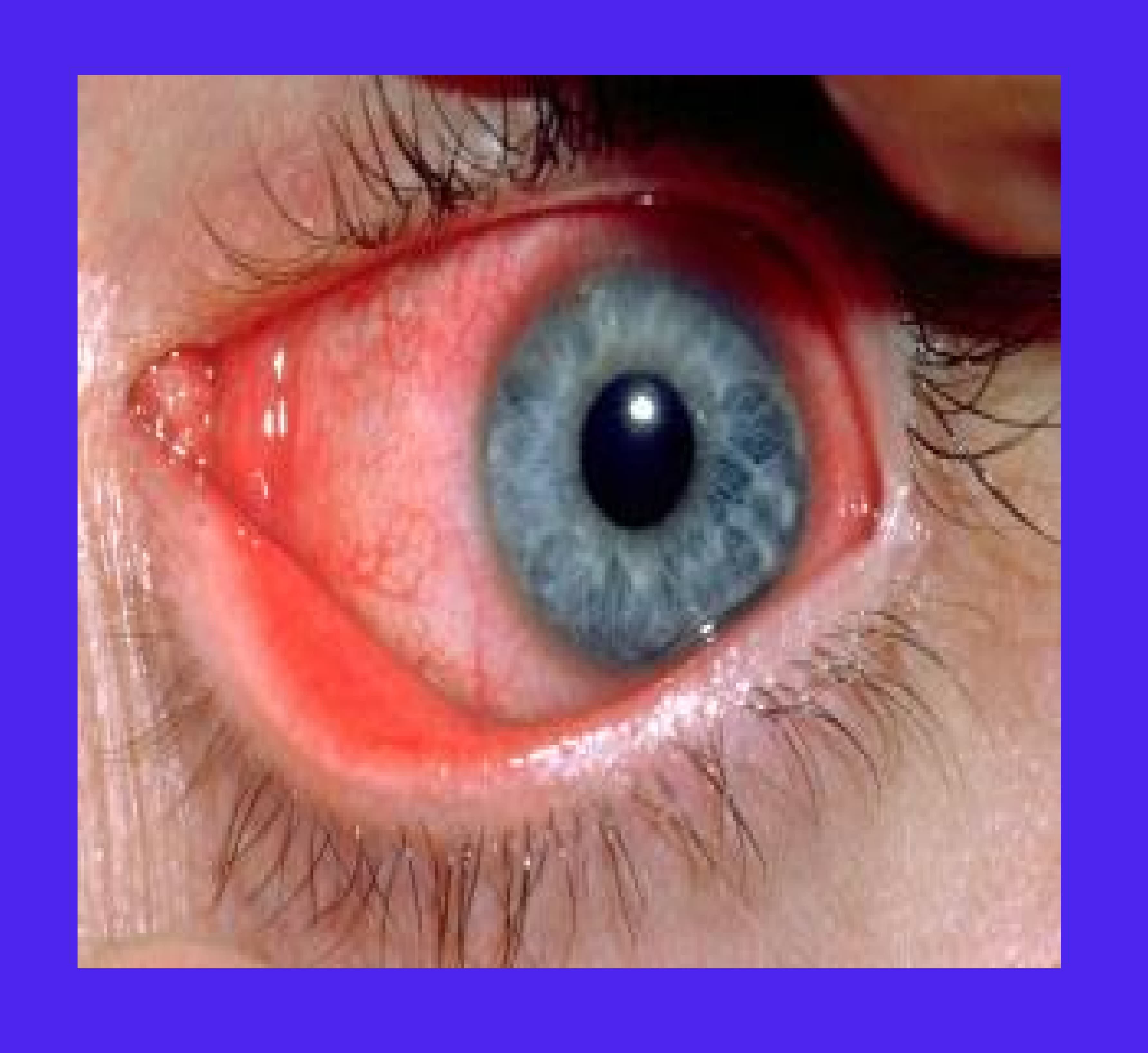 Conjunctivitis service