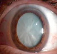 Cataract care