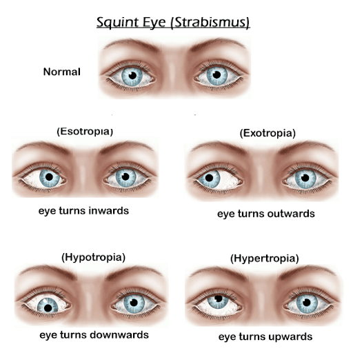 Strabismus service