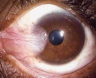 Pterygium service