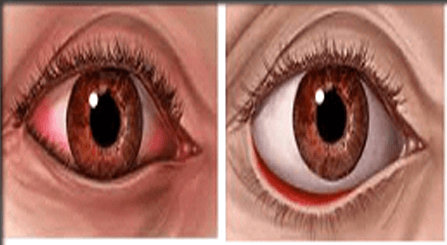 Eyelid conditions